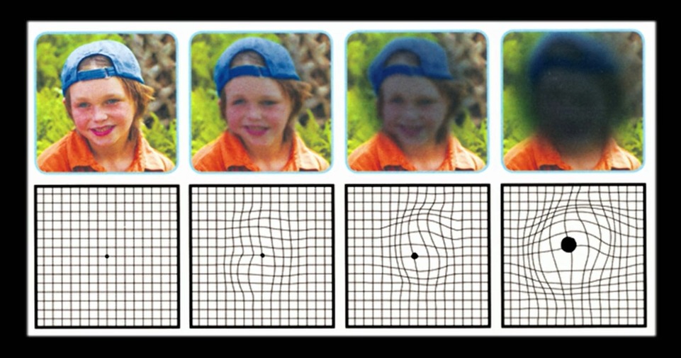 maladie des yeux : schéma de la DMLA