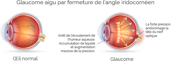 maladie des yeux : schéma du glaucome